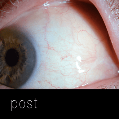 GRASA SUBCONJUNTIVAL: aspecto tras resección del paquete graso, se aprecia una leve cicatriz blanquecina en la parte más lateral.