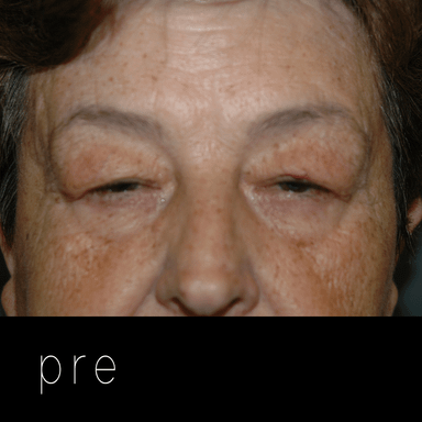 DERMATOCALASIA: párpados caídos por exceso de piel.