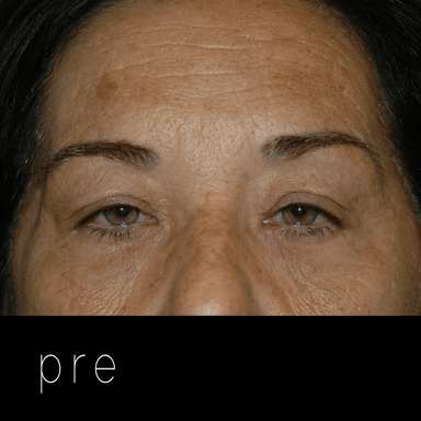 PTOSIS + BLEFARO: dermatocalasia que condiciona párpados caídos.