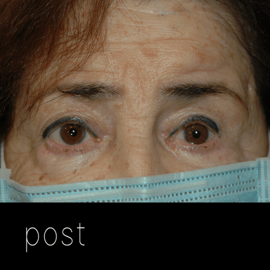 PTOSIS: elevación de ambos párpados + cantoplastia del ojo izquierdo para mejorar simetría.