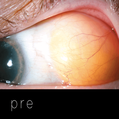 GRASA SUBCONJUNTIVAL: prolapso de grasa orbitaria en lateral externo del ojo.