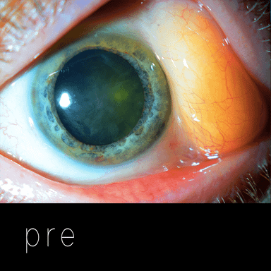 GRASA SUBCONJUNTIVAL: prolapso de grasa orbitaria en lateral externo del ojo.
