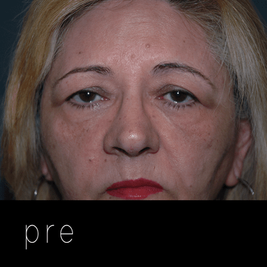 BLEFAROPLASTIA: paciente con párpados caídos por exceso de piel (dermatocalasia) + ptosis de ceja + prolaspso de glándula lagrimal.
