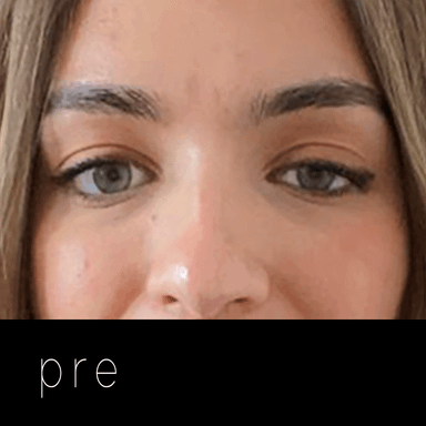 PTOSIS: párpado caído.