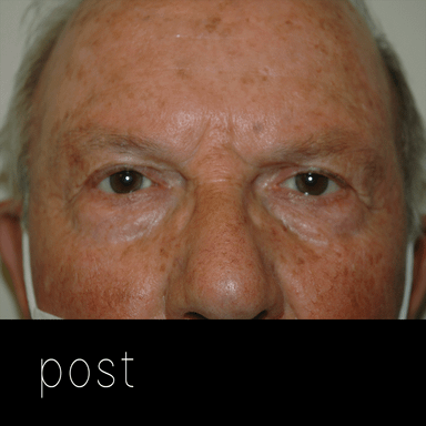 PTOSIS: elevación del párpados mediante cirugía conjuntival (interna) sin cicatrices.
