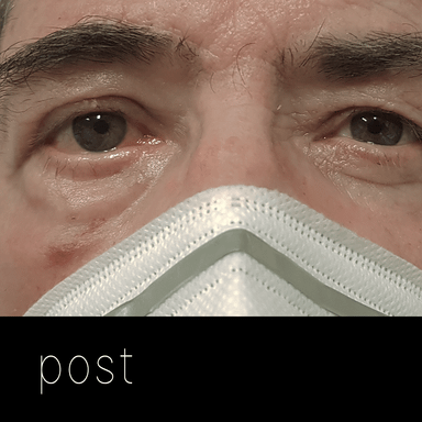 PARÁLISIS FACIAL: aspecto tras elevación de la ceja directa + implante de pesa de oro + tira tarsal y tensado de párpado.