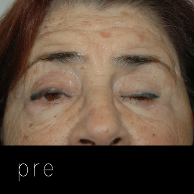 PTOSIS: párpados caídos con hiperfunción compensatoria del músculo frontal (arrugas frente).