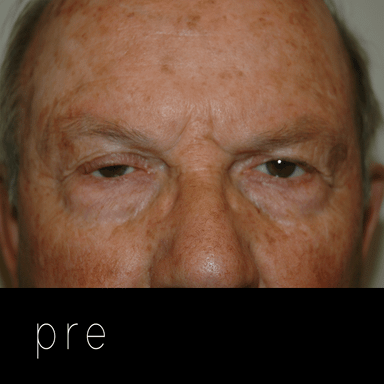 PTOSIS: ambos párpados caídos, mayor descenso del ojo derecho. 