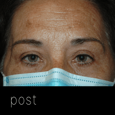 PTOSIS + BLEFARO: cirugía de elevación + blefaroplastia superior.