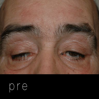 PTOSIS GRAVE: paciente con distrofia miotónica de Steinert.