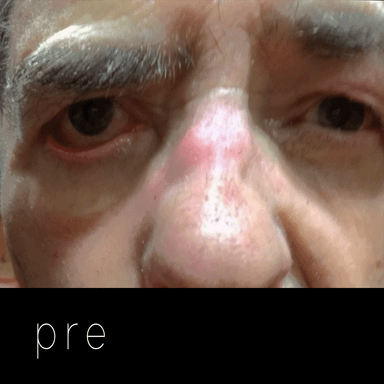 PARÁLISIS FACIAL: ptosis de ceja completa, imposibilidad de cierre y ectropión paralítico de párpado inferior.