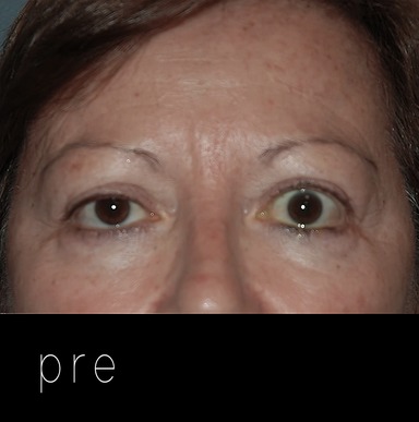 ORBITOPATÍA TIROIDEA: ptosis ojo derecho + retracción del párpado superior izquierdo.