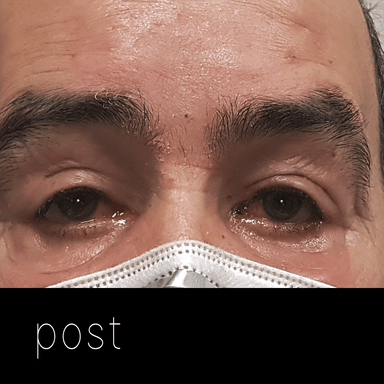 PTOSIS GRAVE: 2 años más tarde el paciente fue operado también del ojo izquierdo, mediante suspensión al frontal.