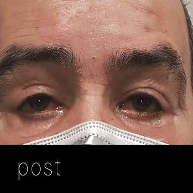 PTOSIS GRAVE: 2 años más tarde el paciente fue operado también del ojo izquierdo, mediante suspensión al frontal.